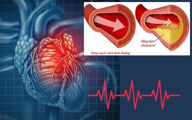 Bệnh tim thiếu máu cục bộ – Thông tin y khoa cần biết để phòng và điều trị