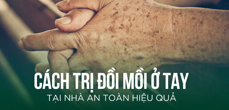 Cách trị đồi mồi ở tay tại nhà bằng nguyên liệu tự nhiên